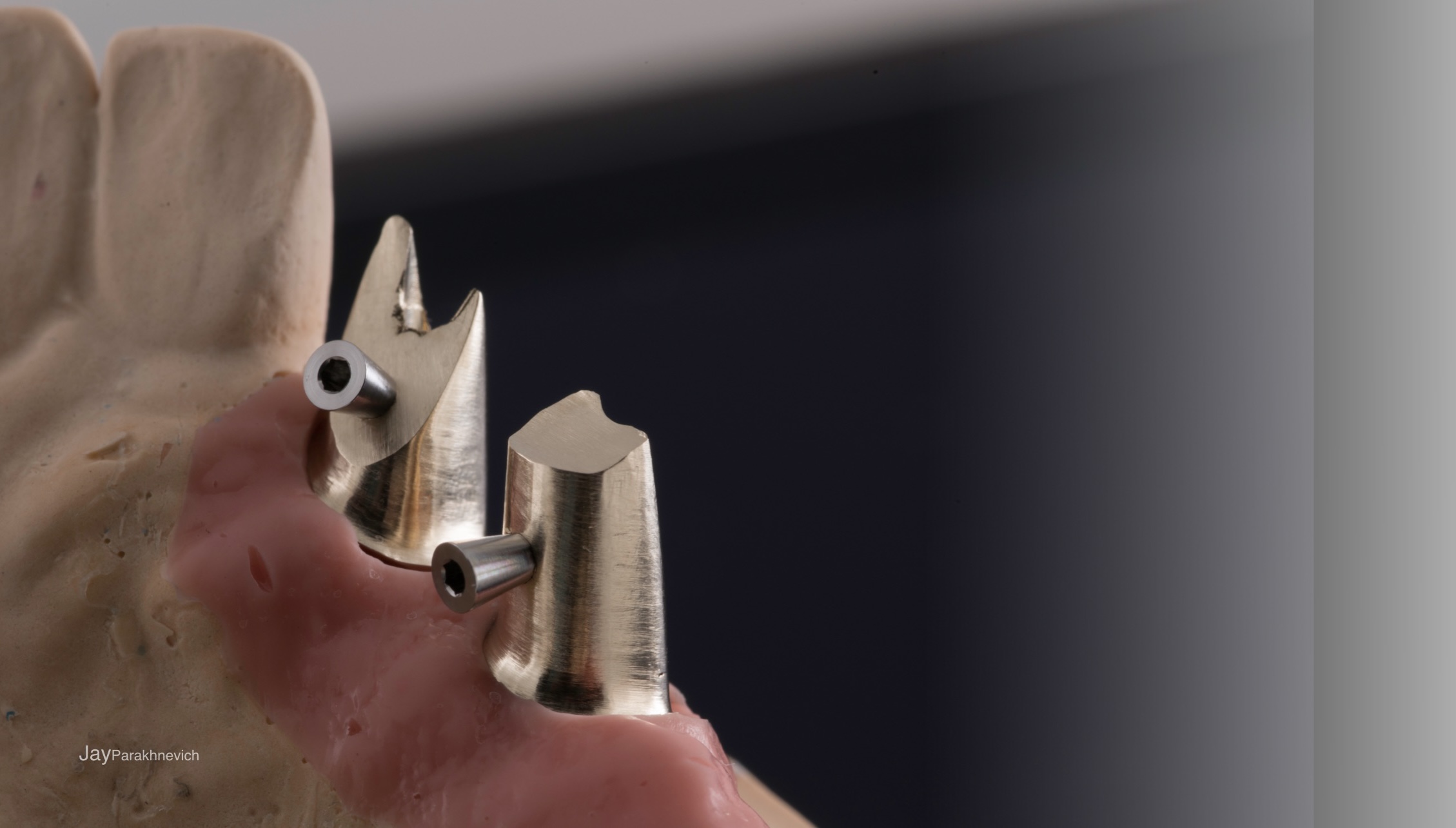 Implant Restoration